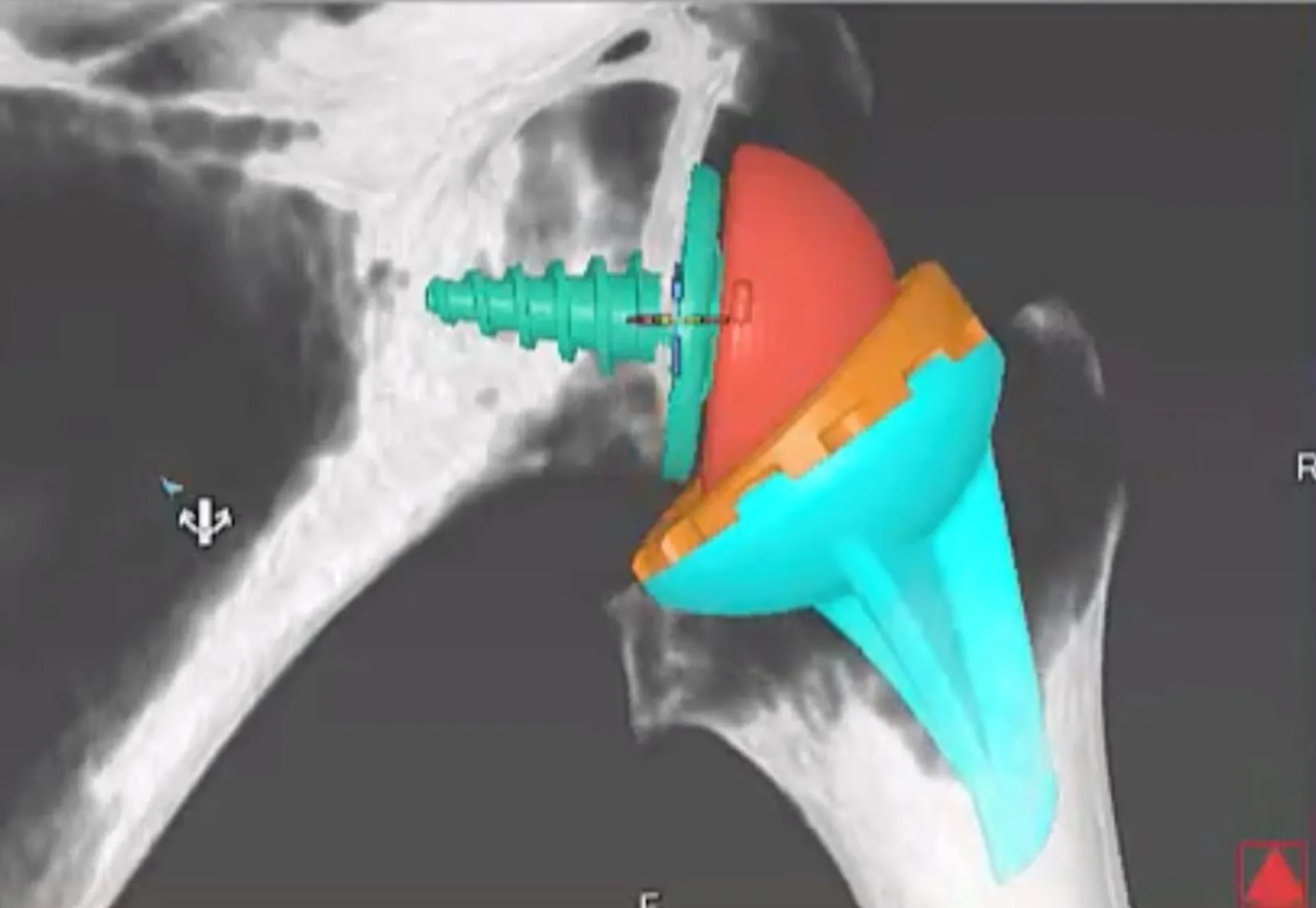 Ανάστροφη Αρθροπλαστική Ώμου: Μία ελάχιστα επεμβατική μέθοδος στο Ιατρικό Κέντρο Αθηνών