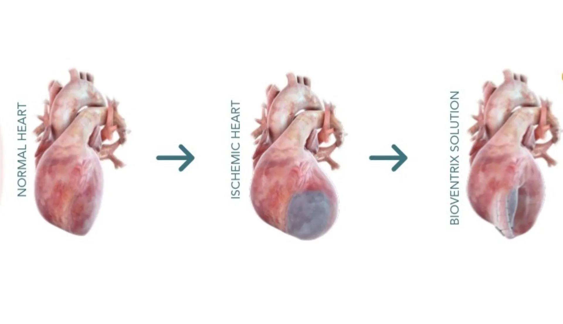 Πρωτοποριακή διαδερμική επέμβαση στο Ιατρικό Διαβαλκανικό για την ανεπάρκεια καρδιάς λόγω εμφράγματος