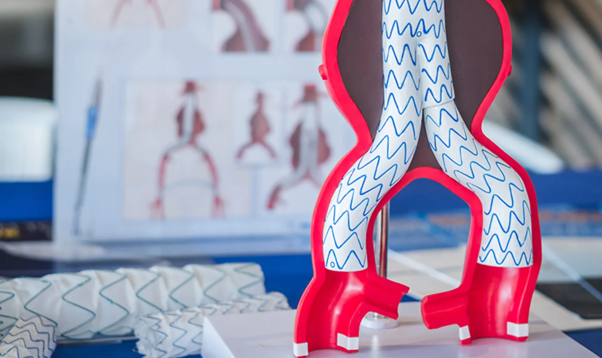 Aνεύρυσμα κοιλιακής αορτής: Παράγοντες κινδύνου  και θεραπεία