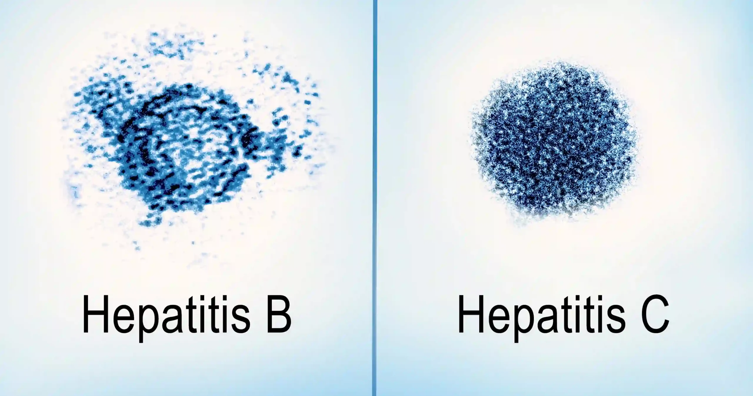 1 εκατ. θανάτους προκαλούν ετησίως οι ηπατίτιδες