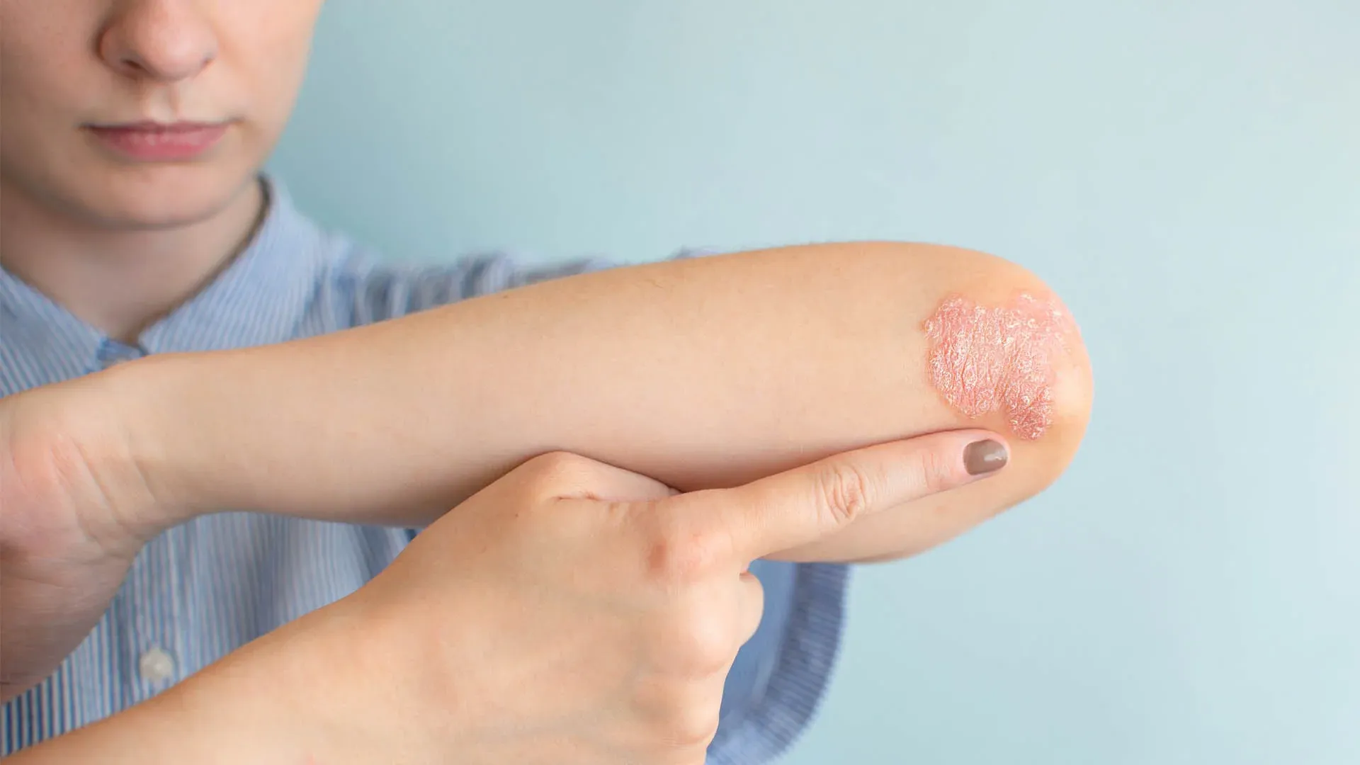 Ψυχολογική υποστήριξη: Μια σπουδαία βοήθεια για τον άνθρωπο με ψωρίαση 