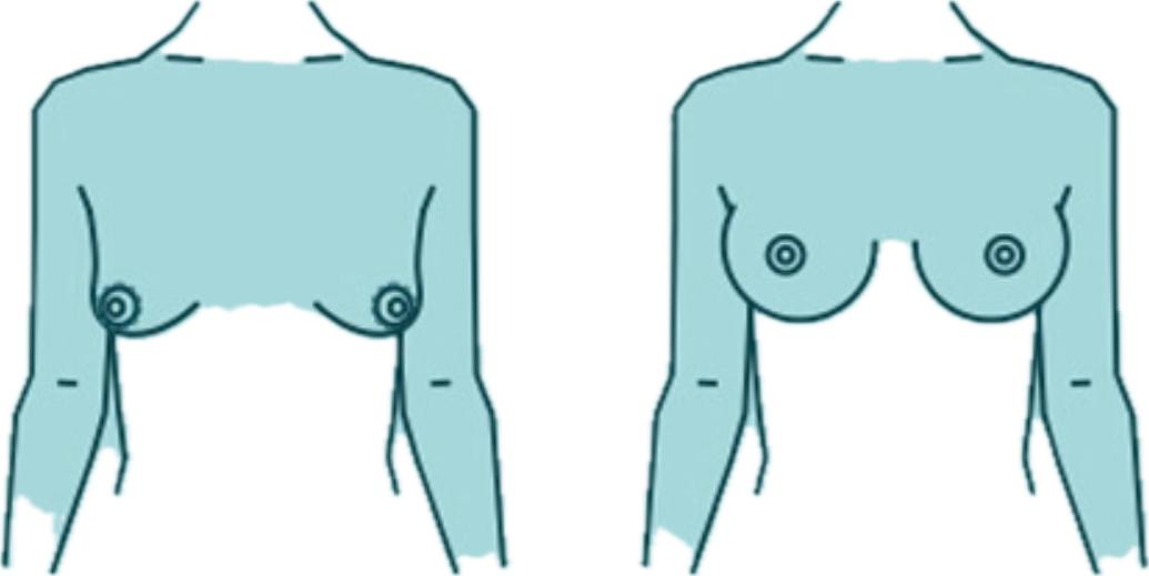 Σωληνωτοί μαστοί: Τι είναι και πώς αντιμετωπίζονται;