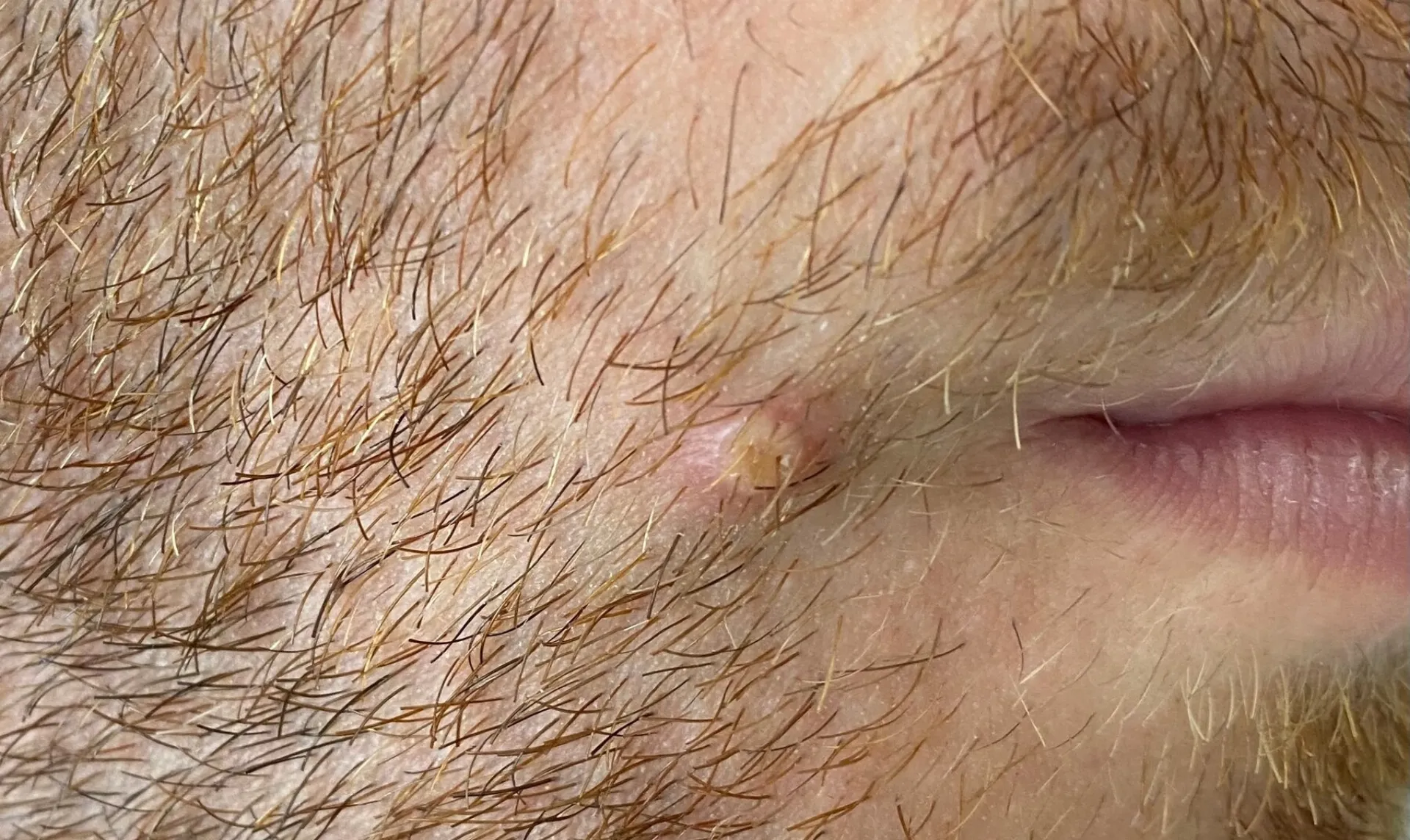 Στη Σουηδία το πρώτο ευρωπαϊκό κρούσμα Ευλογιάς των Πιθήκων